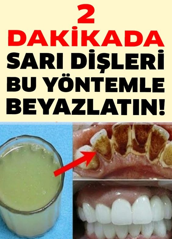 2 Dakikada Sarı Dişleri Bu Yöntemle Beyazlatın ve Ağız Kokusunu Yok Edin